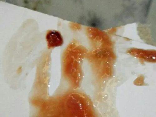 出血大便回事是怎么回事_大便出血是怎么回事_出血大便回事是痔疮吗