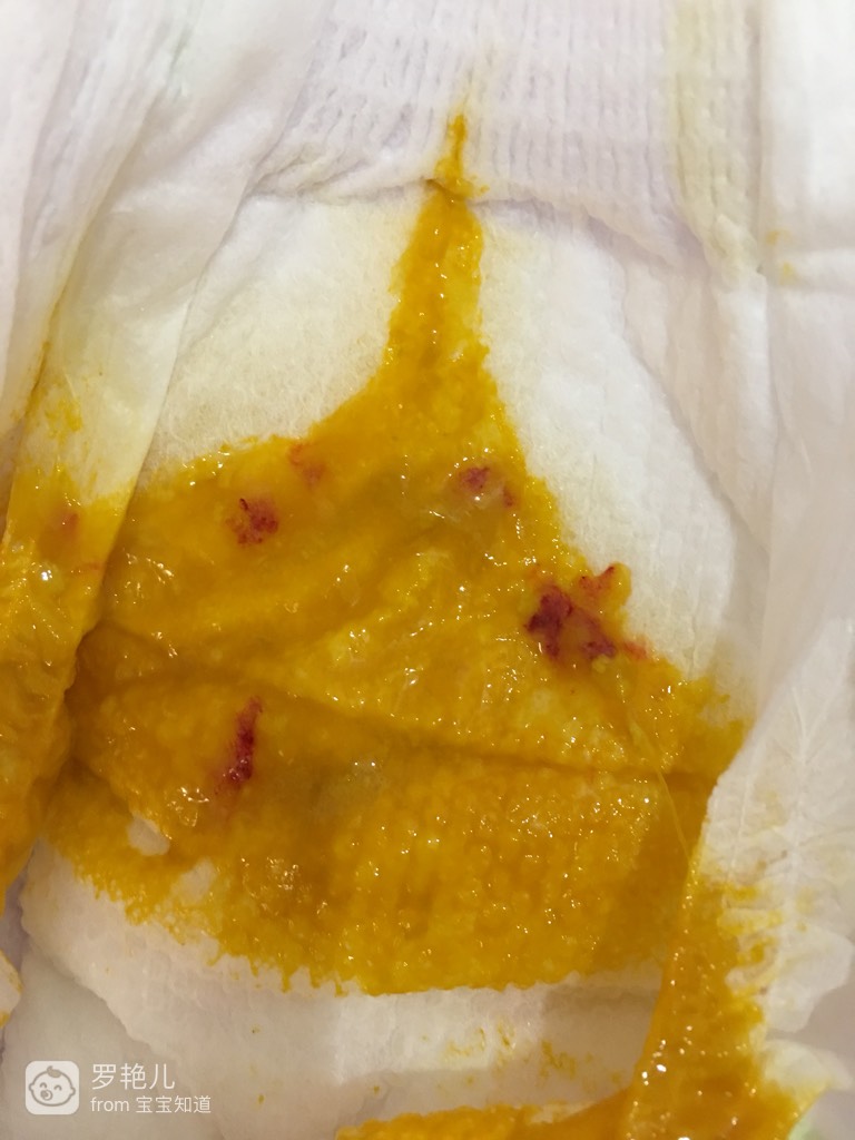 出血拉屎拉来就没了_拉屎拉出血来_出血拉粑粑