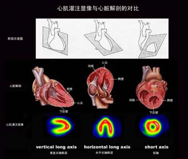 冠心病的病例-年轻人的健康警示：我如何应对冠心病挑战，从健康理所当然到现实警醒